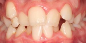 brackets-en-lima-01