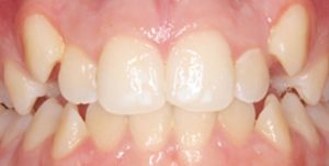 brackets-en-lima-02