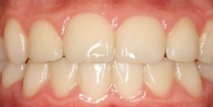 brackets-en-lima-02