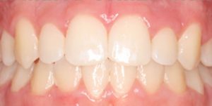brackets-en-lima-03