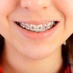 Brackets-en-Lima-en-Zarate-Ortodoncia Brackets-en-Lima-en-Zarate-Ortodoncia
