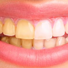 dientes-amarillos dientes-amarillos