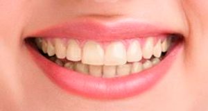 estetica-dental-antes