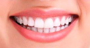 estetica-dental-despues