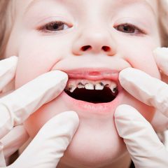 nino-con-caries nino-con-caries