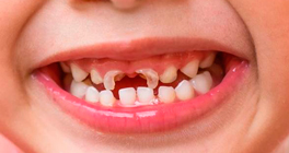 odontoprediatria-antes
